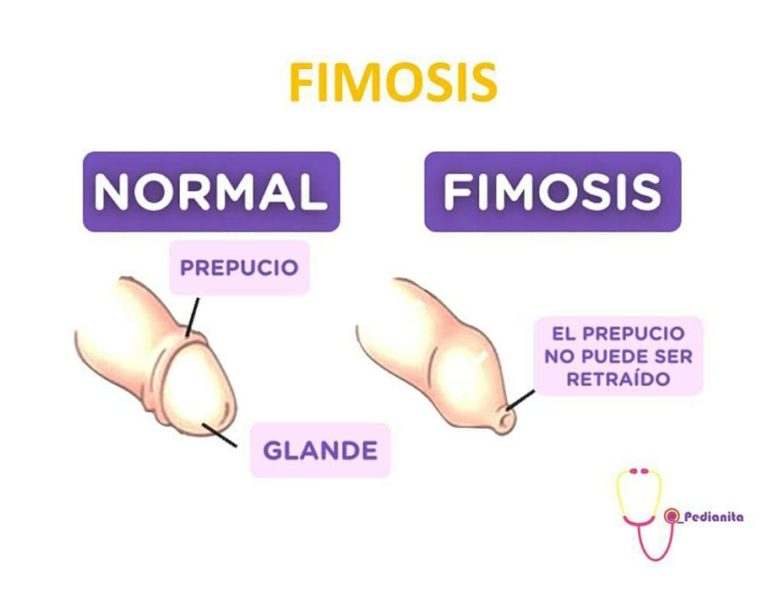 Sunat untuk Penderita Fimosis, Aman Tidak Ya?